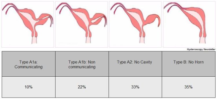 Classification unicornuate uterus