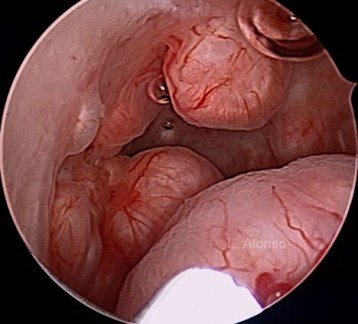 Leiomyomatosis Endometrial 4 copia