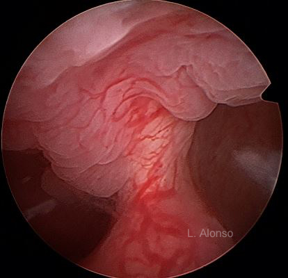 Uterine septum 3 copia
