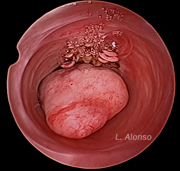 polipo 223 L. Alonso